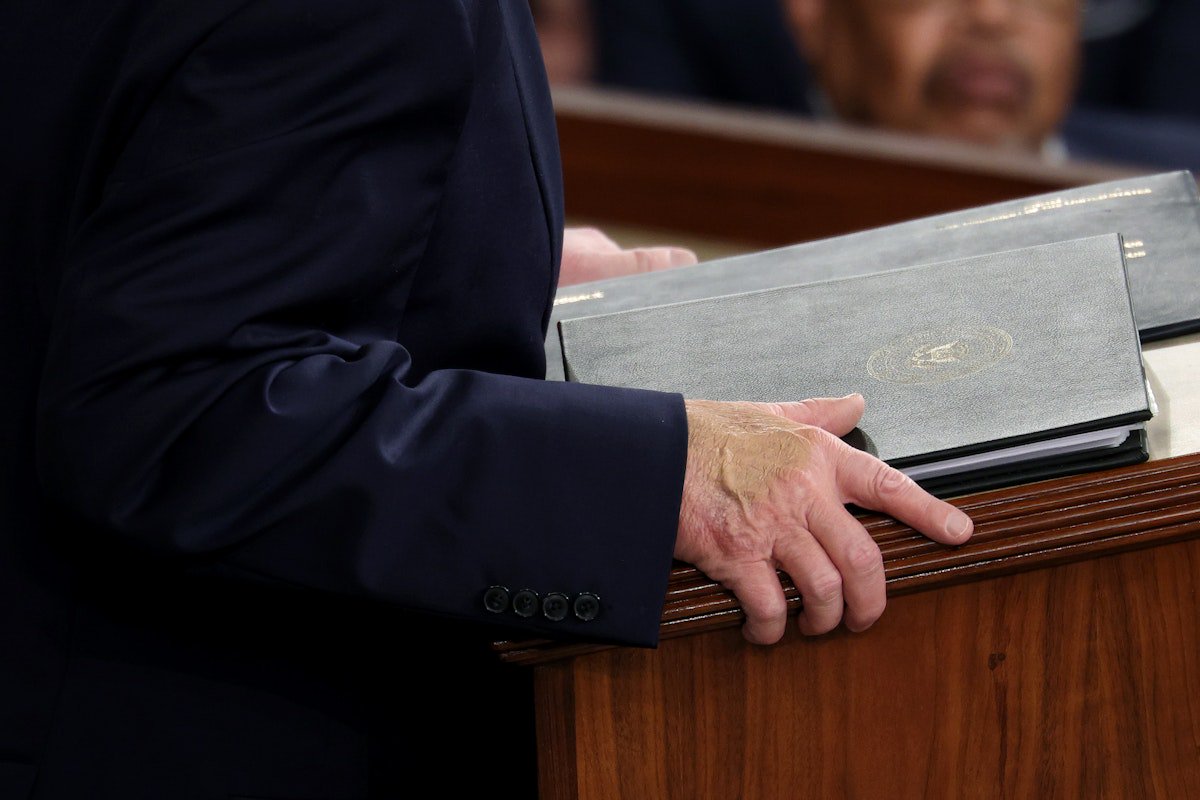Was Trump Hiding His Massive Bruise at the State of the Union?